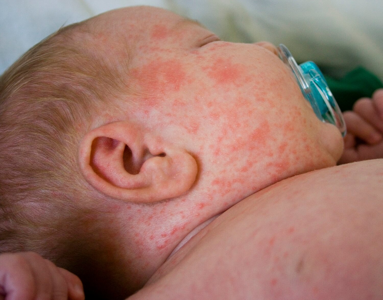 Die Miliaria bei Babys