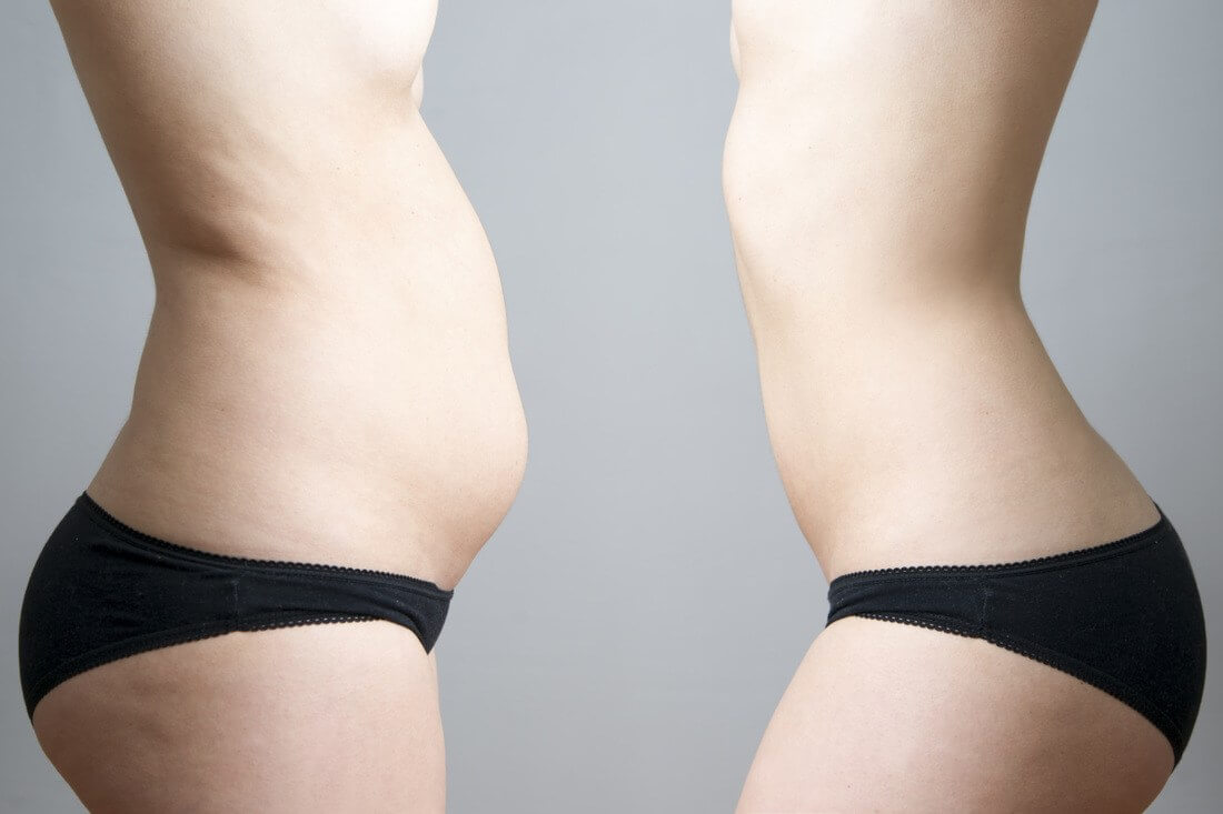 Von der Rektusdiastase erholen - Rektusdiastasis vorher nachher
