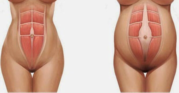 Von der Rektusdiastase erholen - Rektusdiastasis