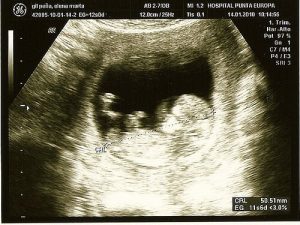 Komplikationen in der Schwangerschaft entdecken - mit innovativer Technik