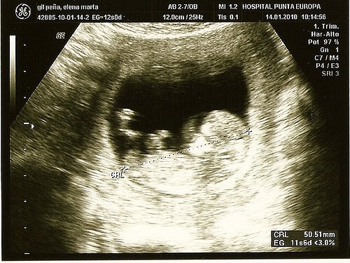 Komplikationen in der Schwangerschaft entdecken - mit innovativer Technik