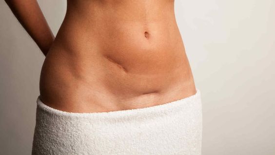 Einfacher Kaiserschnitt Narbe