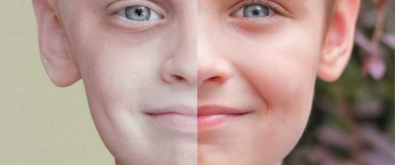 Leukämie bei Kindern