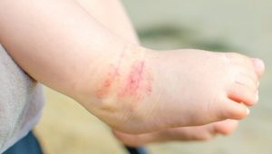 15 Tipps zur Anwendung für Kinder mit Neurodermitis