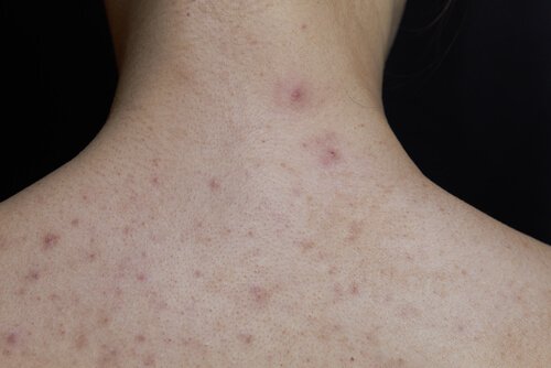 Scharlach bei Kindern