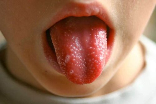 Scharlach bei Kindern: Zunge