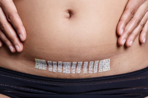 Hysterektomie und Mutter werden