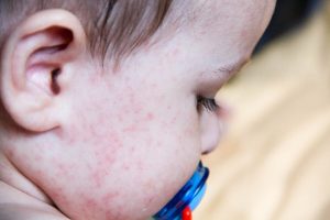 Die häufigsten Nahrungsmittelallergien bei Kindern