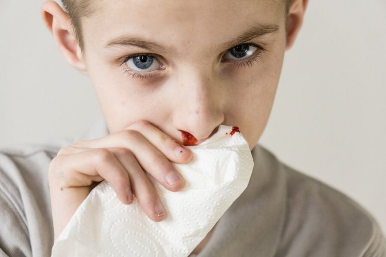Nasenbluten bei Kindern: Ursachen und Behandlung