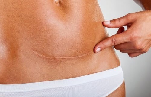 Narbenpflege nach einem Kaiserschnitt