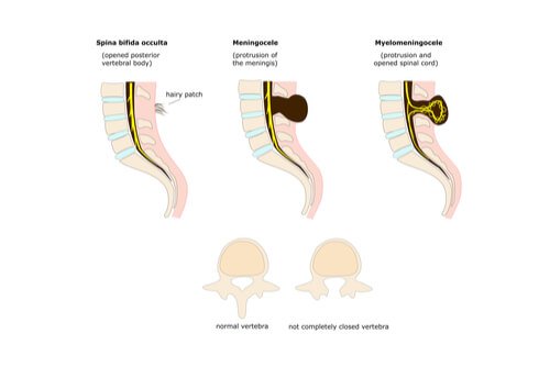Behandlung von Spina Bifida