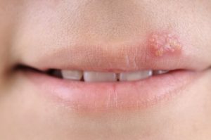 Herpes bei Kindern: Symptome, Ursachen und Behandlung