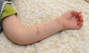 Verbrennungen mit heißem Wasser bei Kindern