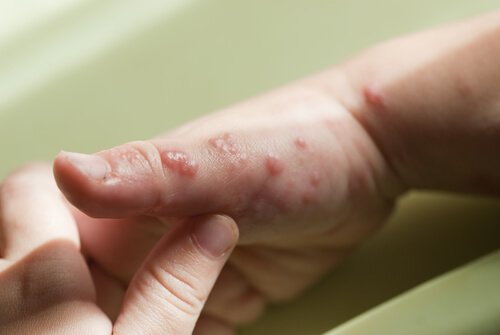 Wie kann Herpes geheilt werden?