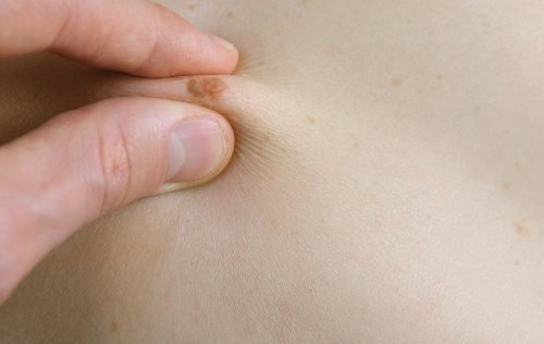 Muttermale sind kreisförmig oder oval