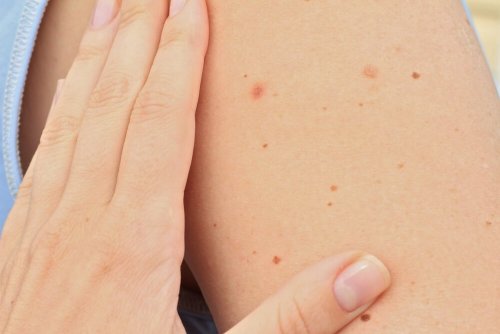 Das Vermeiden von Sonneneinstrahlung kann vor Muttermalen schützen