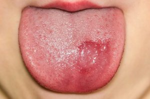 Geographische Zunge bei Kindern: Symptome und Behandlung