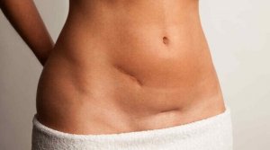 Das Erscheinungsbild von Narben behandeln und reduzieren