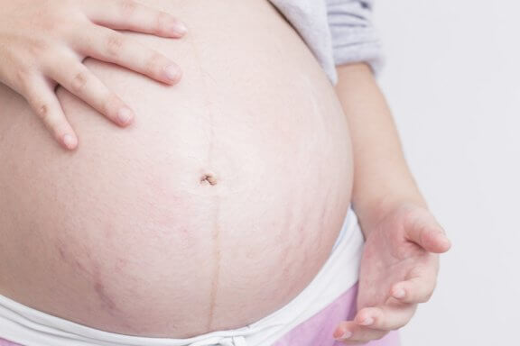 Vorsorge gegen Dehnungsstreifen in der Schwangerschaft