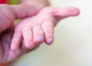 Blasen bei Kindern: Wie kann man sie behandeln?