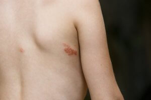 Impetigo contagiosa