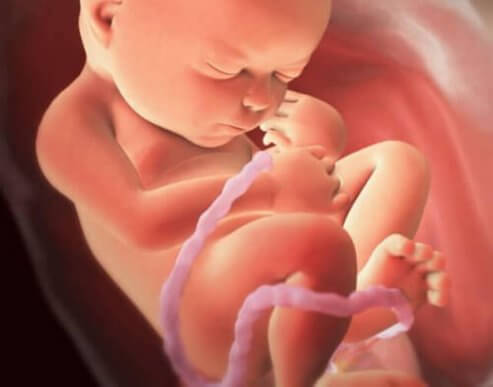 Nabelschnurverwicklung während der Schwangerschaft und Geburt