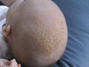 Seborrhoisches Ekzem beim Baby >> Hautkrankheit