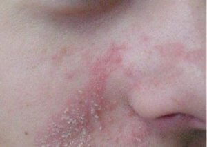 seborrhoisches Ekzem im Gesicht