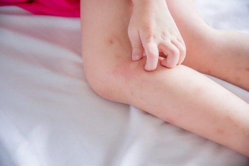 Schweißallergien bei Kindern gehen mit Juckreiz einher