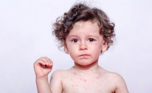 Schweißallergien bei Kindern: Symptome und Behandlung