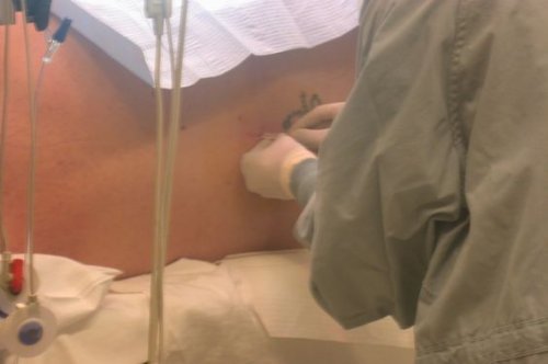 Verabreichung der Peridural- oder Spinalanästhesie während der Operation.