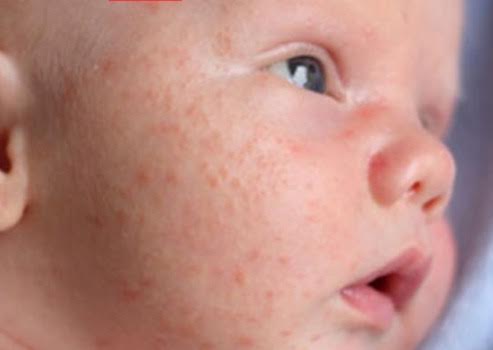 Wissenswertes über Säuglings-Akne