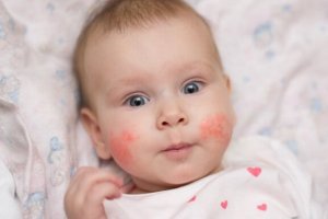 Neurodermitis bei Kindern: Wie du Ausbrüche verhinderst