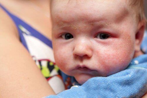Ein Ekzem kann zu flockiger Haut bei Neugeborenen führen