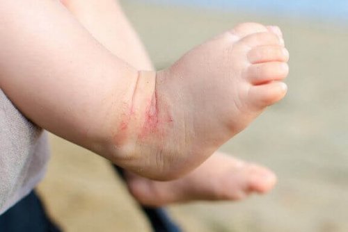 Ekzeme treten oft an Wangen, Kopf und Gliedmaßen auf
