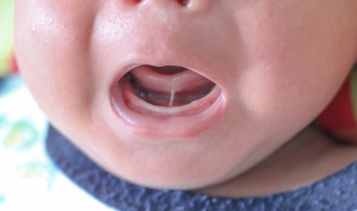 Was ist Ankyloglossia oder Zungenverwachsung?