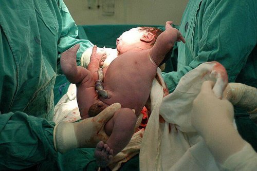 Entbindung eines Babys