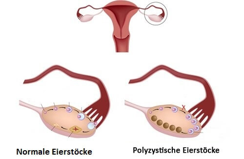 Polyzystisches Ovarialsyndrom: Symptome