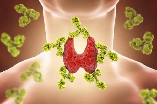 Bei der Hashimoto-Krankheit greift das Immunsystem die Schilddrüse an