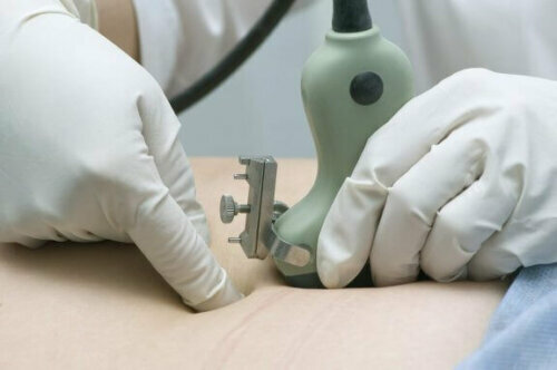 Mit einer Fruchtwassserauffüllung können die Mediziner helfen, den Fruchtwasserpegel wieder zu erhöhen.