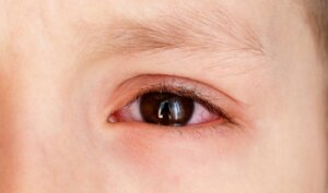 Welche Ursachen hat eine subkonjunktivale Blutung bei Kindern?