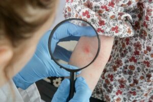 Atopische Dermatitis bei Babys und Kindern: Natürliche Heilmittel