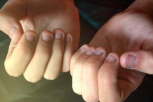 Onychophagie bei Kindern: Was du wissen musst