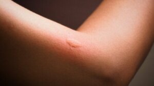 Tipps, um Insektenstiche bei Kindern zu erkennen