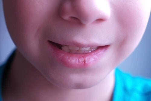 Rissige Lippen bei Kindern: Ursachen und Empfehlungen