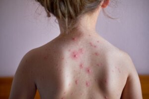 Gürtelrose bei Kindern: Ursachen, Symptome und Behandlung
