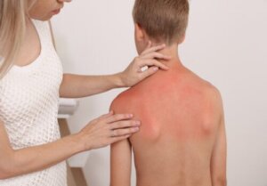 Sonnenbrand bei Säuglingen und Kindern: Was du wissen solltest