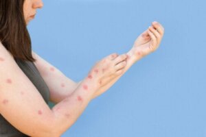 Affenpocken (Mpox) in der Schwangerschaft?